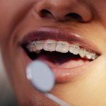 Mennyi ideig kell hordani a fogszabályzót?