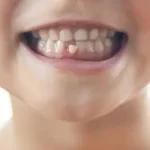 Hány foga van egy csecsemőnek?