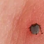 Hogyan kell a kullancsot eltávolítani?