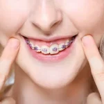 Fogszabályzó: mikor érdemes elkezdeni a kezelést gyermekeknél?